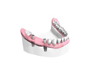 Remplacer plusieurs dents absentes ou abîmées - Dentiste Haguenau