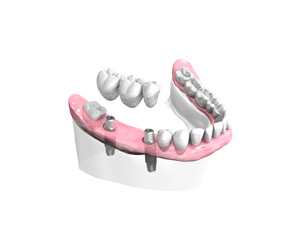 Remplacer plusieurs dents absentes ou abîmées - Dentiste Haguenau