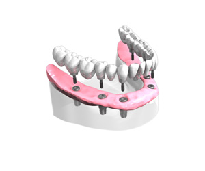 Remplacer toutes les dents absentes ou abîmées - Dentiste Haguenau